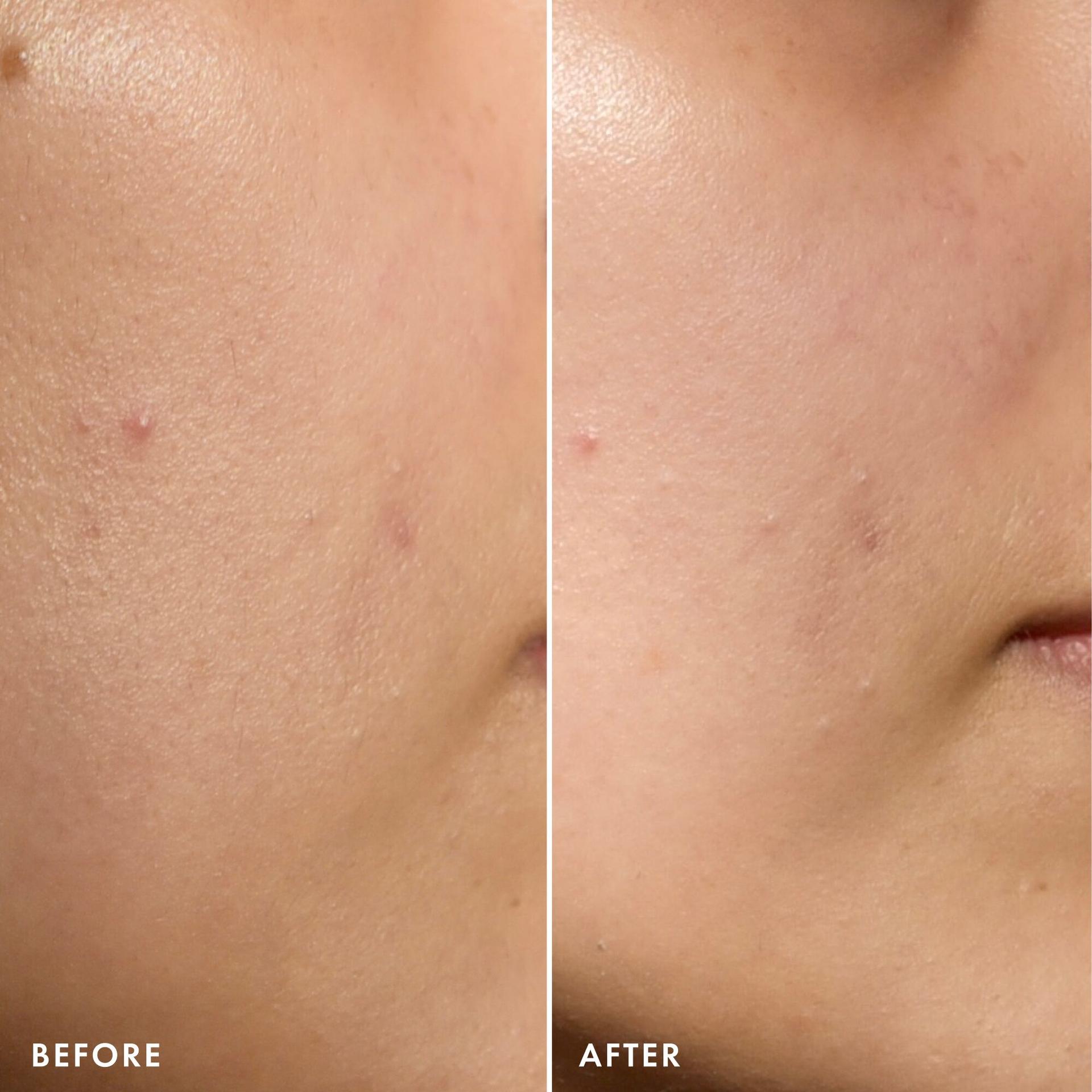 Before and after Youthbomb Double Retinol