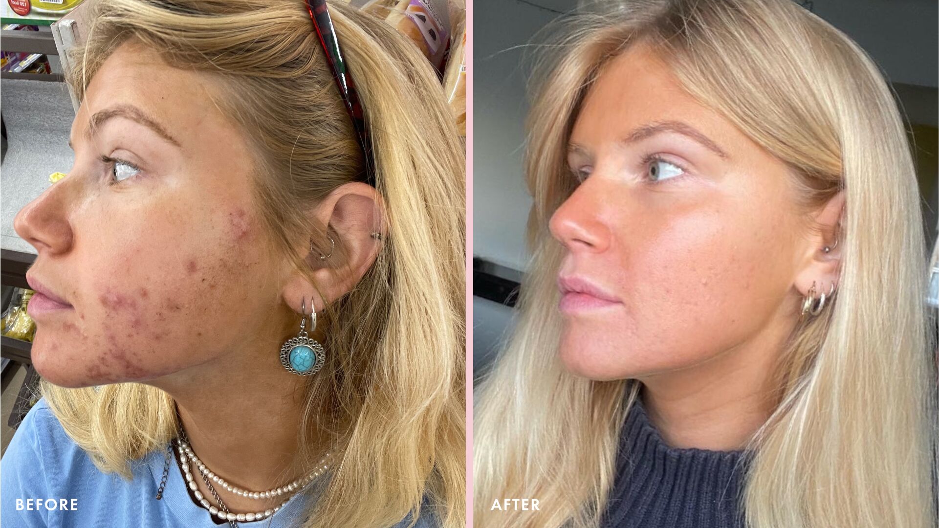 acne-before-after.jpg Millie Godfrey's before and after from acne