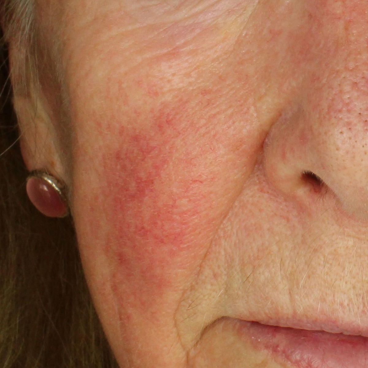 HAPPY_FACE_AZELAIC ACID BEFORE_WEB